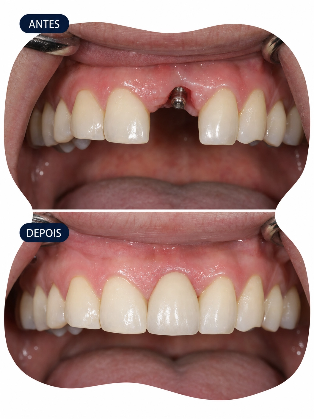 Implante Dentário - OdontoSpecial Barueri